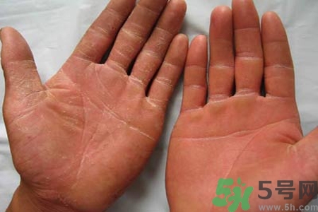 手足癬是什么？手足癬癥狀有什么？