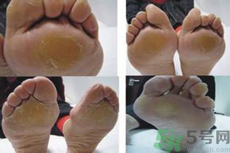 手足癬是什么？手足癬癥狀有什么？