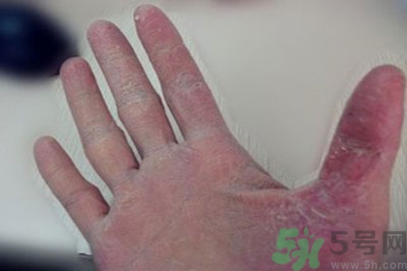 引起手足癬的主要原因？手足癬會(huì)引發(fā)什么疾??？