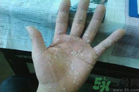 引起手足癬的主要原因？手足癬會(huì)引發(fā)什么疾?。?></p><h3>手足癬會(huì)引發(fā)什么疾病</h3><p>手足癬除了其臨床表現(xiàn)外，還可引起其他疾病。本病可引起丹毒、急性淋巴管炎和急性蜂窩組織炎，故應(yīng)引起臨床醫(yī)生和患者的高度重視。</p>		</div>
<div align=