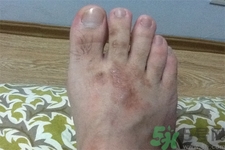 手足癬的治療方法？治療手足癬可以用什么藥？