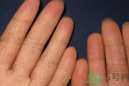 手足癬的治療方法？治療手足癬可以用什么藥？