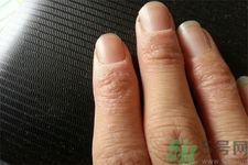 手足癬的治療方法？治療手足癬可以用什么藥？