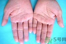 手足癬的治療方法？治療手足癬可以用什么藥？