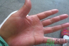 手足癬的易發(fā)人群有哪些？如何預防手足癬？