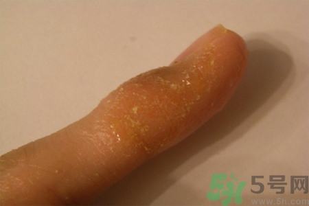 手足癬的易發(fā)人群有哪些？如何預防手足癬？