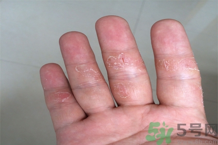 手足癬的易發(fā)人群有哪些？如何預防手足癬？