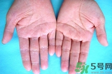 手足癬預(yù)防措施需要注意什么？手足癬飲食要注意哪些？