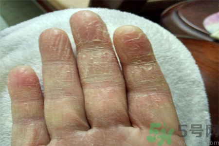 手足癬會傳染嗎？手足癬的傳播途徑有哪些？