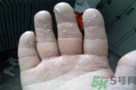 手足癬會傳染嗎？手足癬的傳播途徑有哪些？