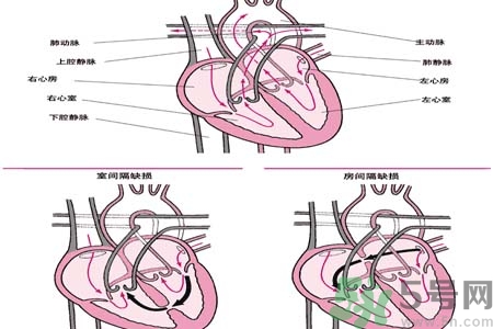 先天性心臟病是什么？先天性心臟病的癥狀有哪些？