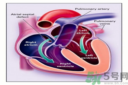 先天性心臟病發(fā)病原因是什么？