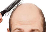 男人禿頂能治好嗎？治療禿頂小偏方