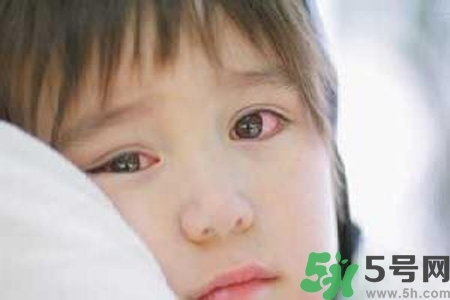 寶寶為什么會感染紅眼?。繉殞毣技t眼病如何治療？