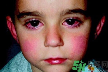 寶寶為什么會感染紅眼病？寶寶患紅眼病如何治療？