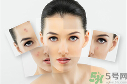 下巴長硬包是怎么回事？下巴長硬包怎么辦？