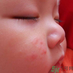 寶寶長(zhǎng)蘚是怎么回事？寶寶長(zhǎng)蘚怎么辦？