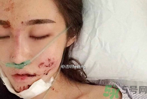 知名網(wǎng)紅被毀容是誰?車禍毀容的賠償標準 知名網(wǎng)紅被毀容是誰?車禍毀容的賠償標準