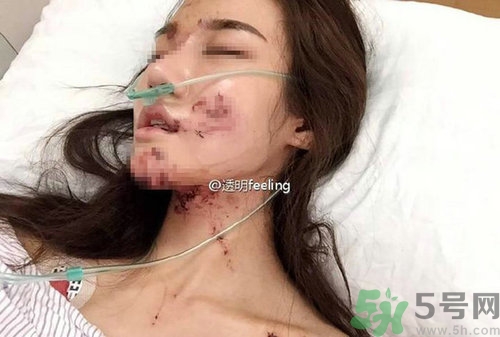 知名網(wǎng)紅被毀容是誰?車禍毀容的賠償標準 知名網(wǎng)紅被毀容是誰?車禍毀容的賠償標準