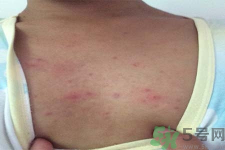 胸部長痘痘怎么回事？胸部長痘痘的原因是什么？