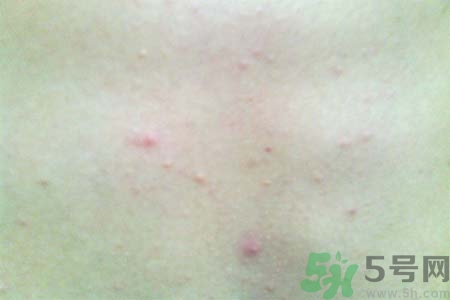 胸部長痘痘怎么回事？胸部長痘痘的原因是什么？