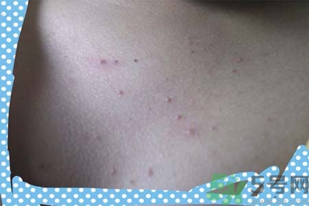 胸部長(zhǎng)痘痘怎么辦？胸部長(zhǎng)痘痘需要注意什么？