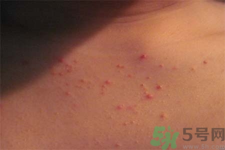 胸部長(zhǎng)痘痘怎么辦？胸部長(zhǎng)痘痘需要注意什么？