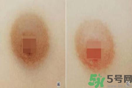 乳頭發(fā)黑怎么辦？怎么樣可以使乳頭變白？