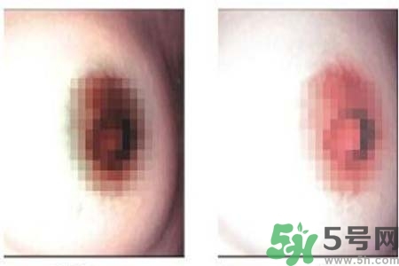 乳頭發(fā)黑怎么辦？怎么樣可以使乳頭變白？