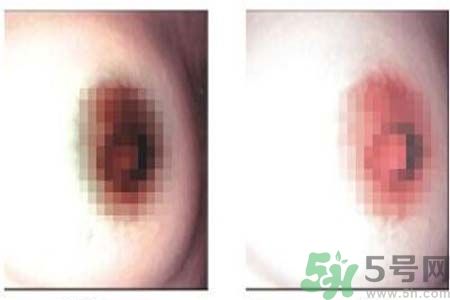乳頭發(fā)黑是怎么回事？乳頭發(fā)黑是什么原因？