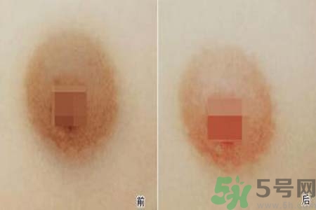 乳頭發(fā)黑是怎么回事？乳頭發(fā)黑是什么原因？