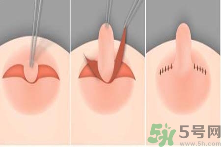 乳頭內(nèi)陷怎么回事？乳頭內(nèi)陷的原因是什么？