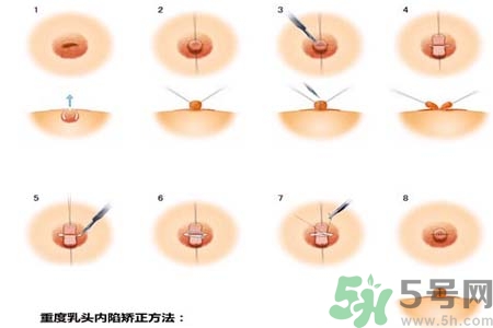 乳頭內(nèi)陷怎么回事？乳頭內(nèi)陷的原因是什么？