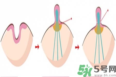 乳頭內(nèi)陷怎么辦？乳頭內(nèi)陷的癥狀有哪些？