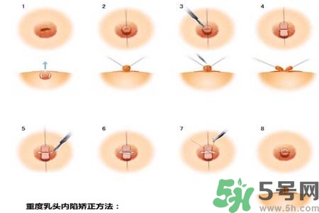 乳頭內(nèi)陷怎么辦？乳頭內(nèi)陷的癥狀有哪些？