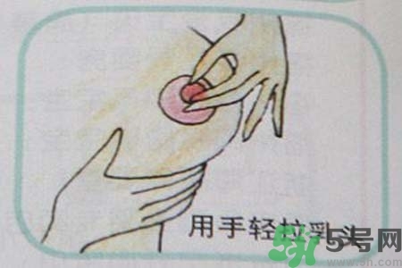 乳頭內(nèi)陷怎么辦？乳頭內(nèi)陷的癥狀有哪些？