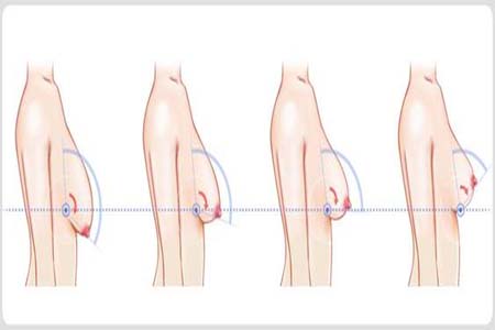 胸部松弛的原因是什么？胸部松弛該怎么辦？