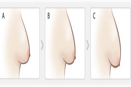 如何預(yù)防胸部松弛？吃什么能使胸部挺拔？