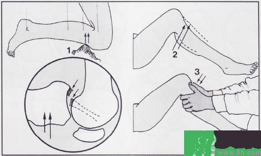 韌帶斷裂吃什么好得快？前十字韌帶斷裂吃什么補品？