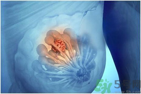 乳房屋硬塊有疼痛感怎么回事？乳房屋硬塊有疼痛感怎么辦？