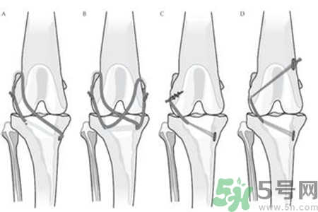 前十字韌帶斷裂可以參加比賽嗎？前十字韌帶斷裂怎么治療？