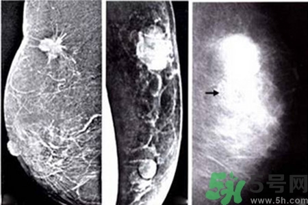 產(chǎn)生乳腺增生鈣化的病因是什么？乳腺增生怎樣治療？
