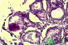 產(chǎn)生乳腺增生鈣化的病因是什么？乳腺增生怎樣治療？