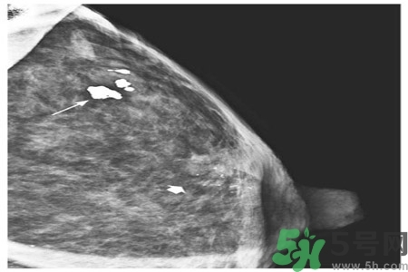 乳腺增生鈣化是什么？乳腺鈣化的癥狀有哪些？