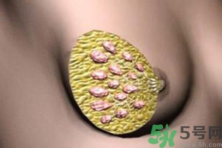 乳腺增生鈣化是什么？乳腺鈣化的癥狀有哪些？