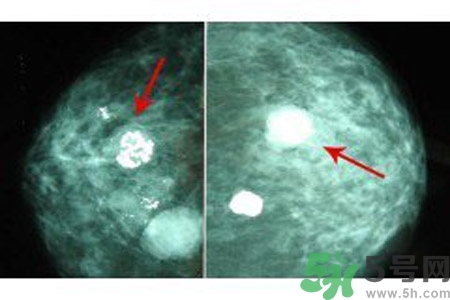 乳腺增生鈣化是什么？乳腺鈣化的癥狀有哪些？