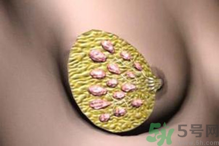 產(chǎn)生乳腺增生鈣化的病因是什么？乳腺增生怎樣治療？