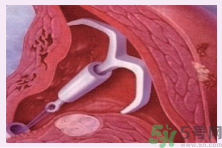 什么是自然避孕法？如何能知道自己的孕期？