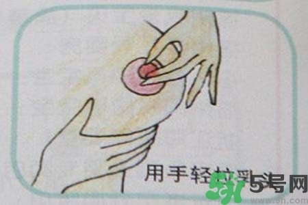 乳頭內(nèi)陷怎么矯正？乳頭內(nèi)陷矯正方法是什么？