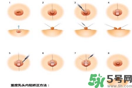 乳頭內(nèi)陷怎么矯正？乳頭內(nèi)陷矯正方法是什么？